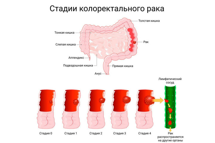 Жителям Хакасии дали советы для профилактики рака толстого кишечника