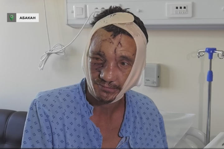 В Хакасии восстановили лицо мужчине, пострадавшему от лап медведя