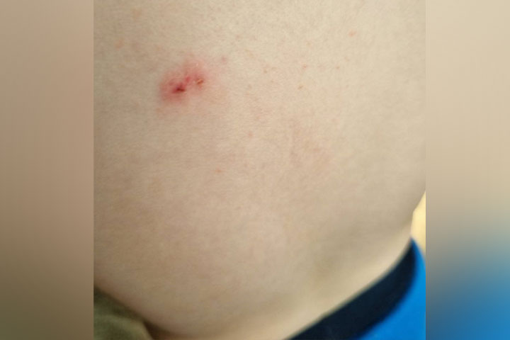 Крыса укусила 2-летнего мальчика возле детсада